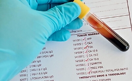 Dispositivo per rilevare i marcatori tumorali, premio per due ricercatori catanesi