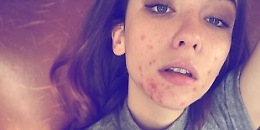 Matilda De Angelis: al Festival di Sanremo un'attrice che non nasconde il volto "mangiato dall'acne"