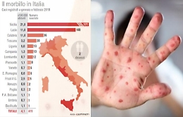 Morbillo in Sicilia, piano straordinario
di vaccinazioni anche per gli adulti