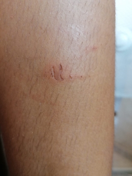 Mascali (CT) : bimba morsa al mare , forse da un barracuda