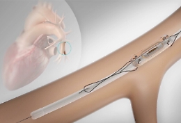 Scompenso cardiaco, impiantato a Catania il primo sensore wireless che avvisa i medici se qualcosa non va