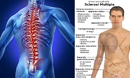 In Sicilia ora c'è il registro della sclerosi multipla: è la prima regione in Italia