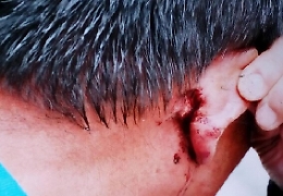 Bagheria, stacca il lobo dell'orecchio a morsi a un passante dopo rimprovero