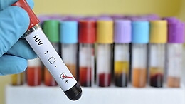 Giornata mondiale contro l'Aids, «a Catania serve più prevenzione per fermare le nuove infezioni»