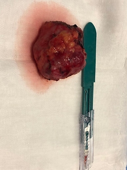 La tecnica "clampless" in 3D sull'unico rene di una donna a Catania