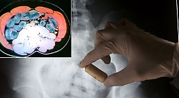 Corriere della droga ghanese fermato a Favara con 10 ovuli nella pancia