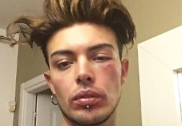 Cazzotti in faccia a Stash per difendere una donna. E lui racconta tutto sui social