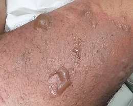 Meduse killer e numerose nelle acque dell'agrigentino