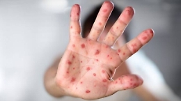 Morbillo, nel 2018 segnalati 2.368 casi: in Sicilia l'incidenza più alta