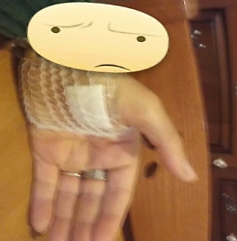 Ho girato le farmacie di Giarre, Fiumefreddo, Riposto, Acireale e Catania senza trovare un'antitetanica