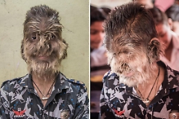 Spagna, sindrome del "lupo mannaro" per 17 bambini