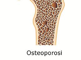Osteoporosi, la Sicilia terza regione italiana per diffusione