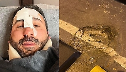 Lo chef Natale Giunta furioso dopo caduta dal monopattino: «Grazie a Palermo per le tante buche»