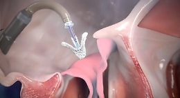 Valvola tricuspide: addio bisturi a Catania nuova e complessa procedura mininvasiva