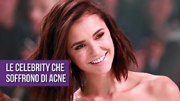 Le celebrity che soffrono di acne