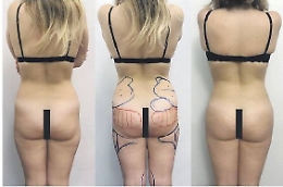 Liposcultura 3D per rimodellare le proprie curve