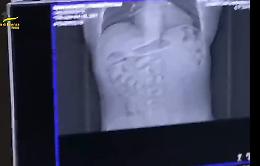 Nello stomaco aveva ovuli con 1,5 kg di cocaina: arrestato