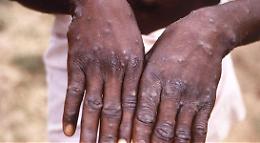 Vaiolo delle scimmie, per ora 6 i contagi in Italia dovuti a «rapporti sessuali». 