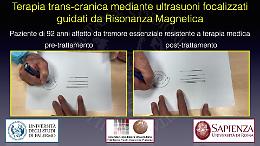 L'intervento al cervello per eliminare il tremore ad una mano