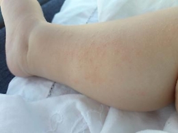 Dermatite atopica, in estate sotto controllo con gel facili da spalmare