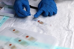 Vaiolo delle scimmie, lunghe file a New York per vaccinarsi