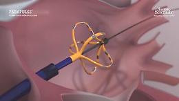 Fibrillazione atriale, sistema Farapulse per ablazione non termica