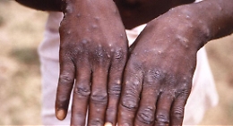 Vaiolo delle scimmie: per l'Oms è "emergenza globale", in Italia 407 casi
