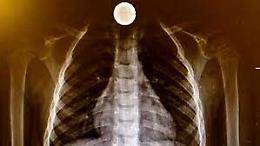 Piccolo turista di 2 anni ingoia moneta da 2 euro: paura, ma &egrave; salvo