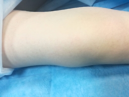 Al Garibaldi di Nesima intervento innovativo su un paziente di 10 anni con un osteosarcoma