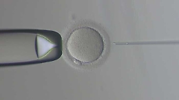 Incinta di due gemelli con ovociti donati 14 anni fa