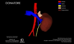 Il trapianto di rene senza anestesia: miracolo della chirurgia a Bologna
