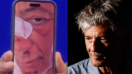 «Atterro di faccia»: la caduta (autoironica) di Fiorello in bicicletta, il racconto dal palco e la foto delle ferite
