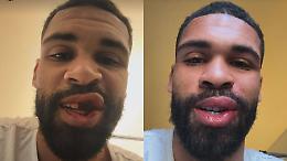Spavento per Loftus-Cheek: il calciatore del Milan posta la foto senza denti dopo il fallo subito