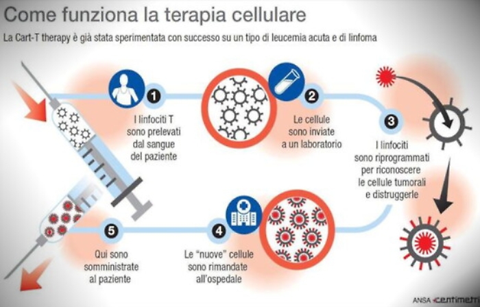 Tumori del sangue, somministrata per la prima volta in Sicilia l'immunoterapia Car-T