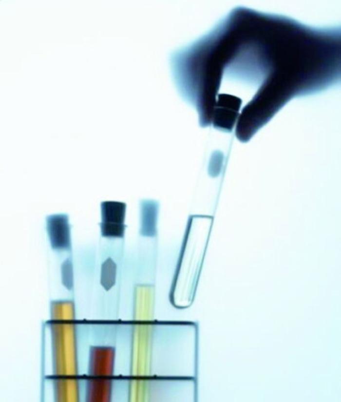 Malattie rare, Antonio, 6 anni, è l'unico in Sicilia con la leucinosi