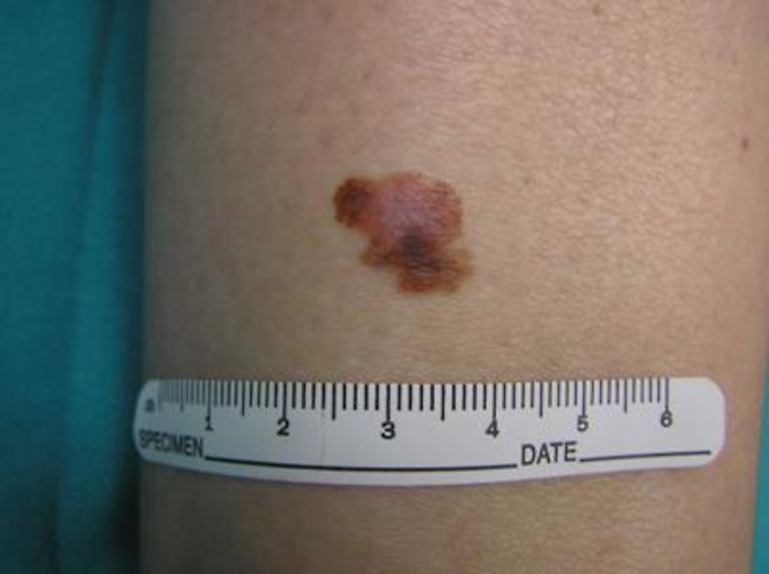 Tumori: melanoma, in Italia 147 mila persone vivono dopo la diagnosi