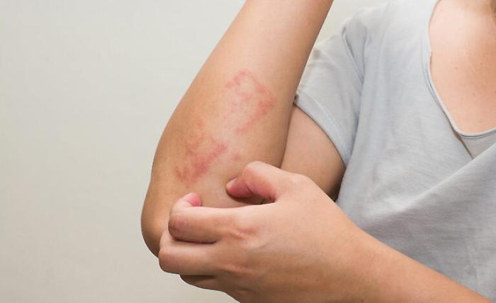 Psoriasi, un nuovo farmaco ottiene la rimborsabilita dallAifa