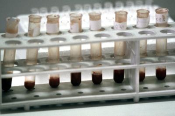 Da Ecdc allarme tetano, in Italia primato casi in Europa