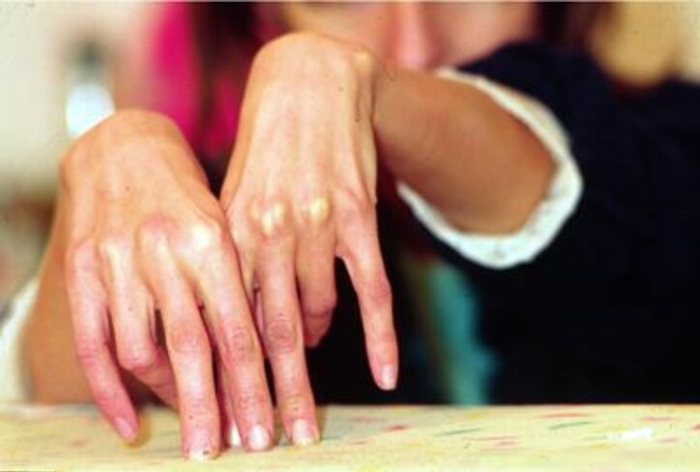 Medicina: artrite reumatoide, 60% in remissione con cure precoci ed efficaci