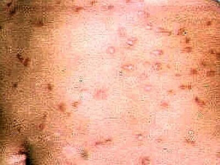 Medicina: dolore e vescicole, Herpes zoster per 150-200 mila italiani l'anno