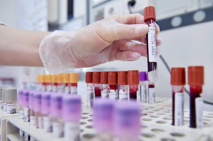 Scoperto un nuovo caso di meningite ad Agrigento