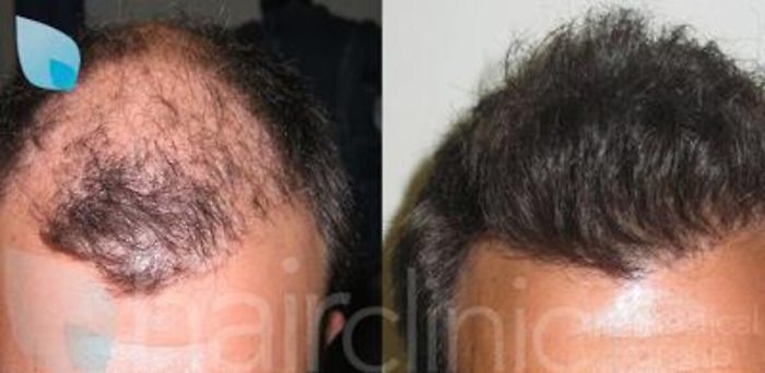 Staminali: nuova arma contro la calvizie