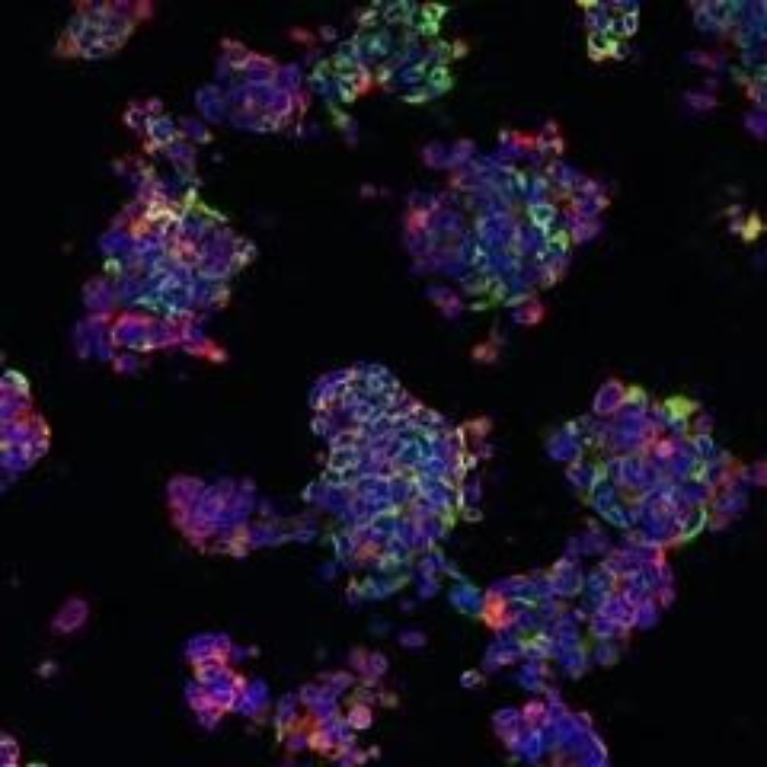 Staminali: cerebrali contro sclerosi multipla, trattati 3 pazienti italiani