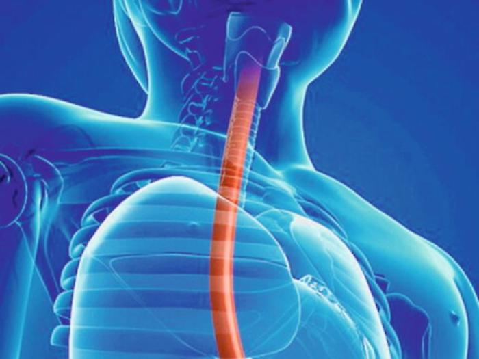 Un esofago bioartificiale totalmente frutto dell'ingegno di due siciliani