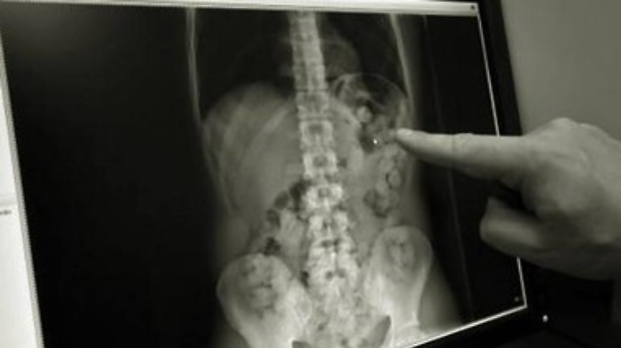 Pozzallo, nascondeva l'eroina dentro alcuni ovuli che aveva ingerito: arrestato