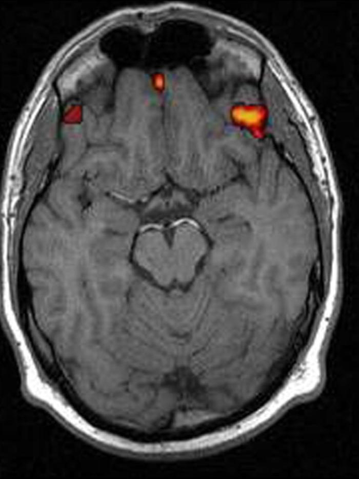 Cervello, trovata 'culla' schizofrenia