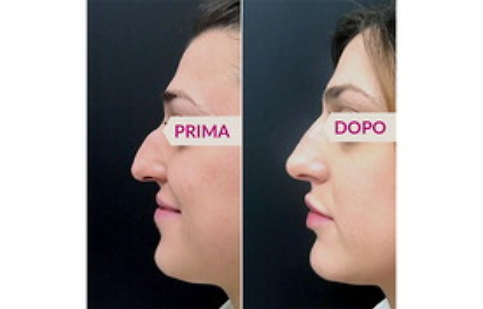 rinofiller_distefano