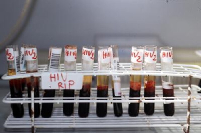 Medicina: da studio su israeliani e palestinesi nuova luce su colesterolo buono