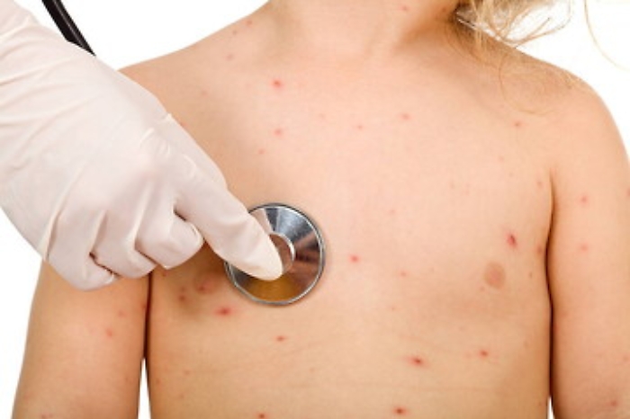 Casi di morbillo, Istituto Superiore di Sanit&agrave;: in Sicilia l'incidenza pi&ugrave; alta