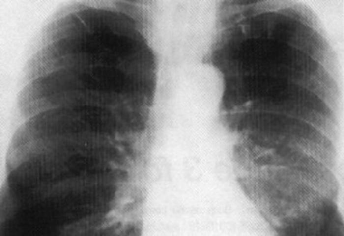 Farmaci: Bpco ruba respiro a 2,6 mln italiani, triplice terapia per forme gravi